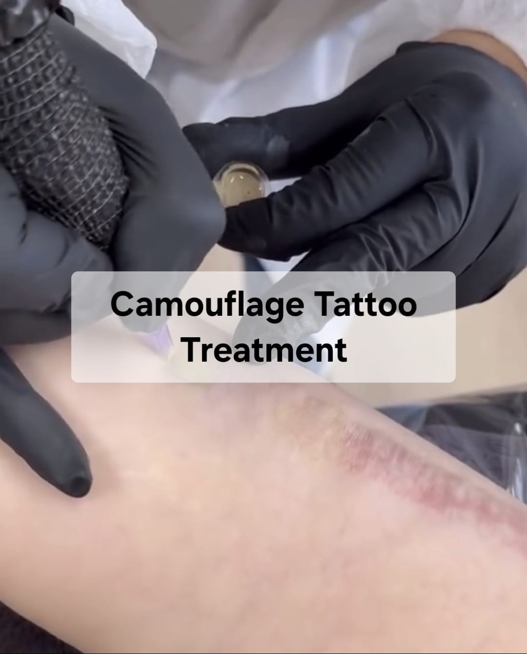 Scar Camouflage Tattoos