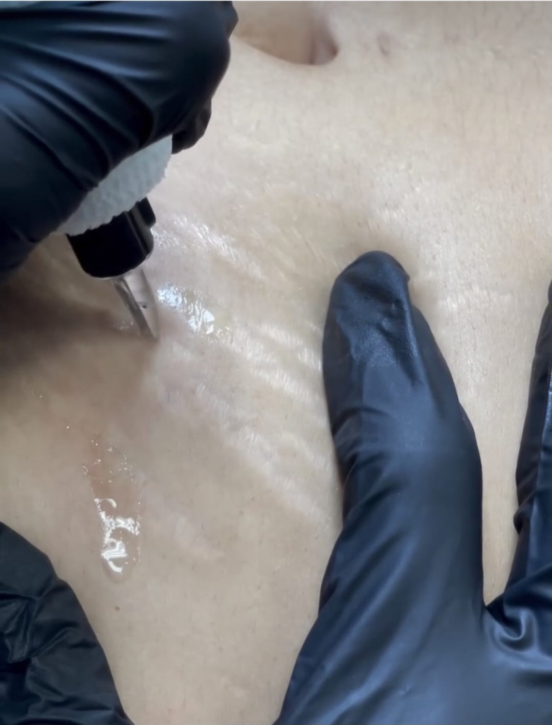 Scar Camouflage Tattoos