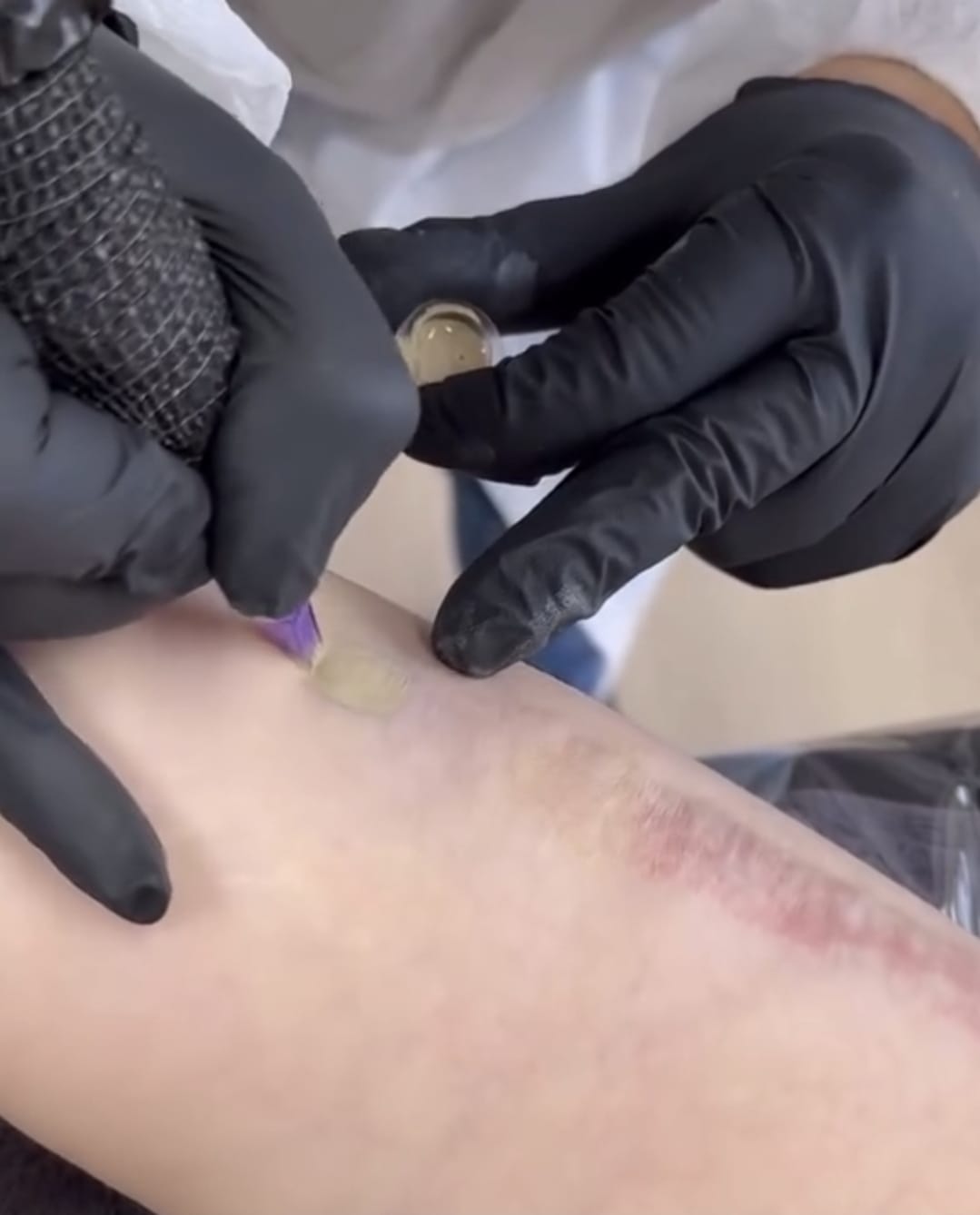 Scar Camouflage Tattoos