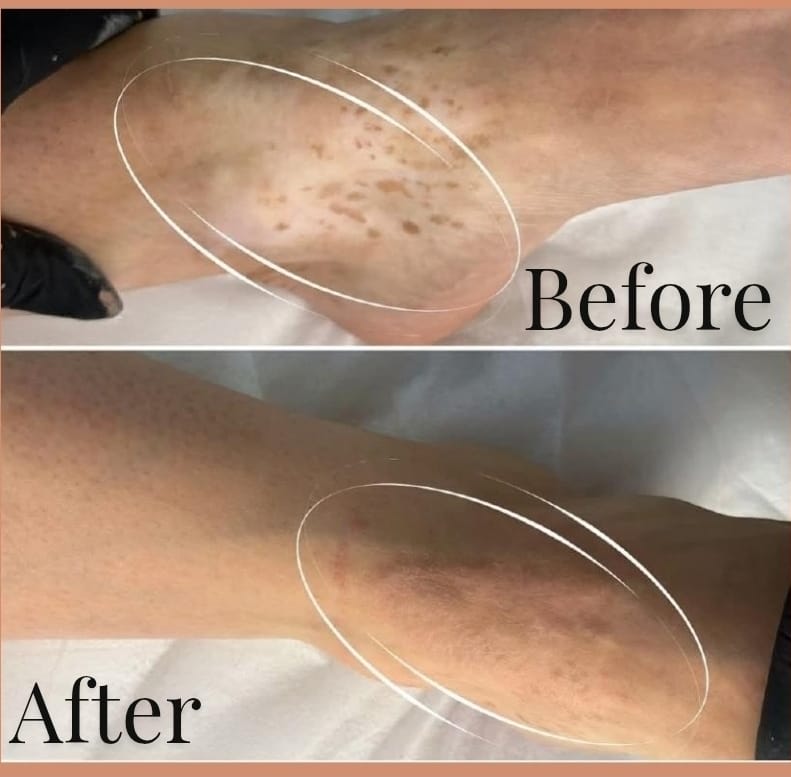 Vitiligo Medical Tattooing
