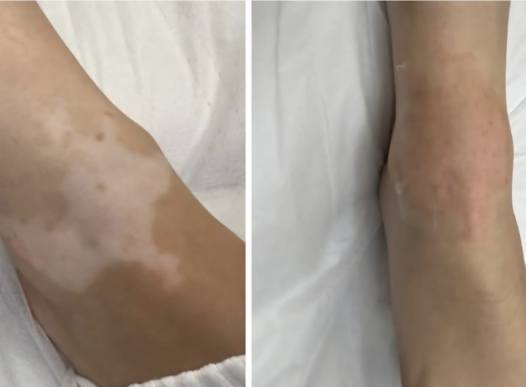 Vitiligo Medical Tattooing