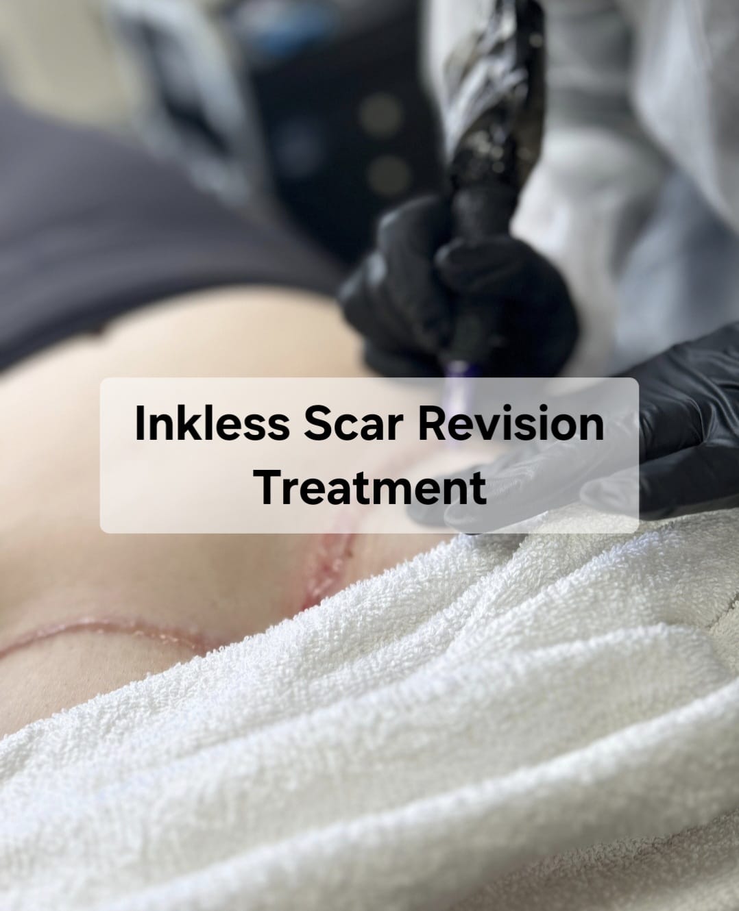 inkless scar revision