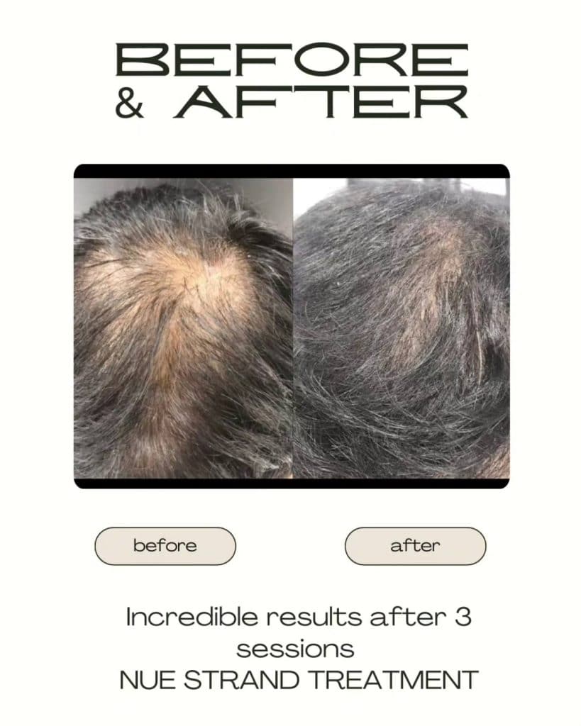 Hair regrowth results after advanced hair growth serum treatment