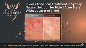 Acne Scar Treatment