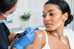 Is Medical Tattooing for Vitiligo Right for You?