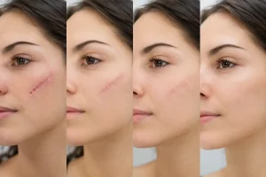 Scar Revision Healing Timeline: What to Expect